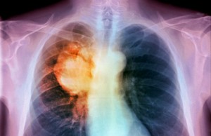 Tumori: l’Aiom spiega come creare fondi per cercare una cura (FOTO)