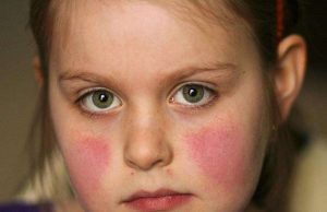 Lupus: uno su due non stringerebbe la mano a chi ne è affetto