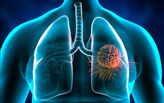 Adenocarcinoma polmonare: sintomi, diagnosi, stadi e cure